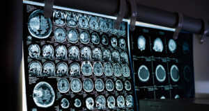 Andalucía introduce la terapia ‘TTFields’ en hospitales públicos para combatir el glioblastoma