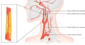 La estenosis de las arterias carótidas puede progresar sin síntomas hasta causar un ictus